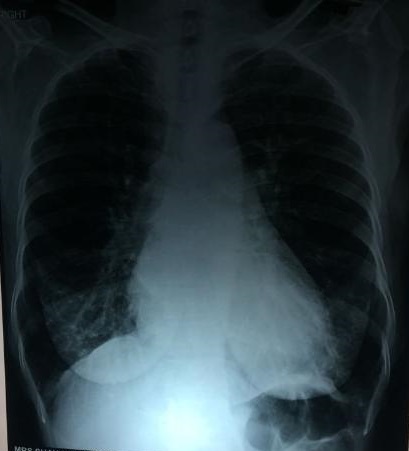 Is It X-ray Picture Of Pulmonary Hypertension? 