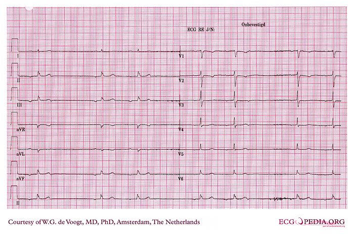Interpret The ECG Findings