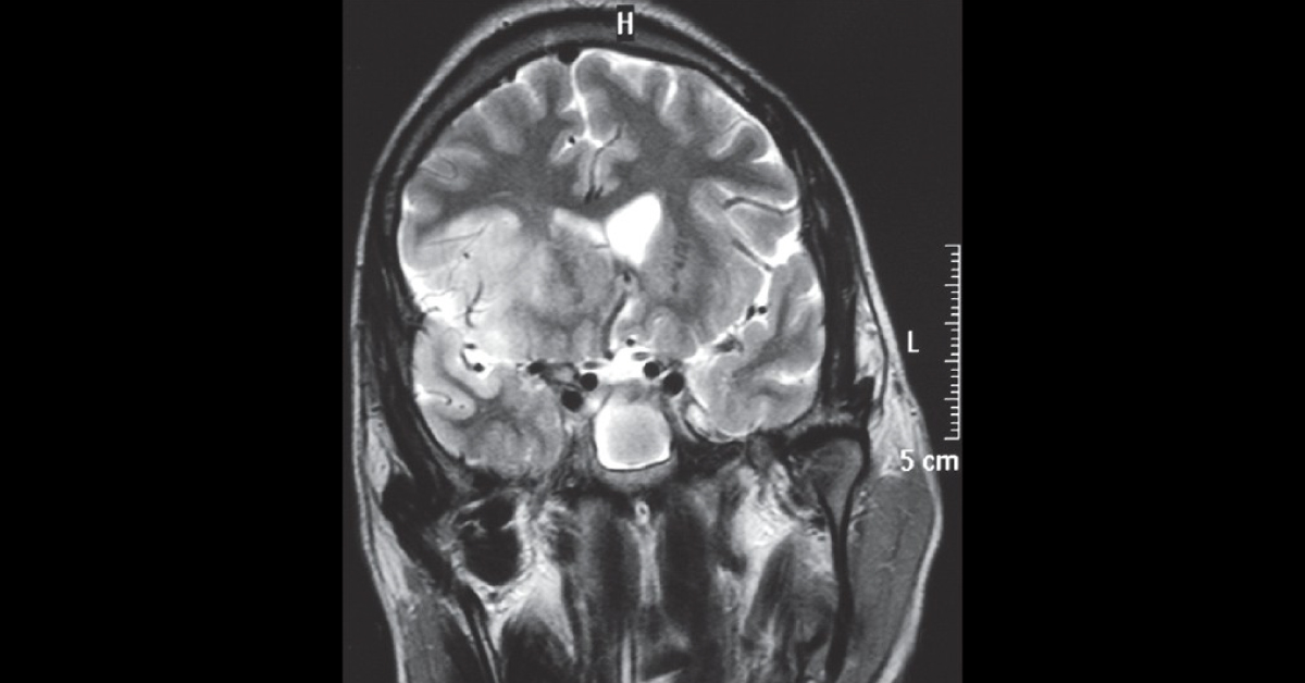 Diagnosis For Sudden Onset Left Hemiparesis