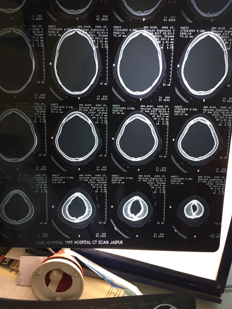 Skull bone thickness in this patient is normal or abnormal