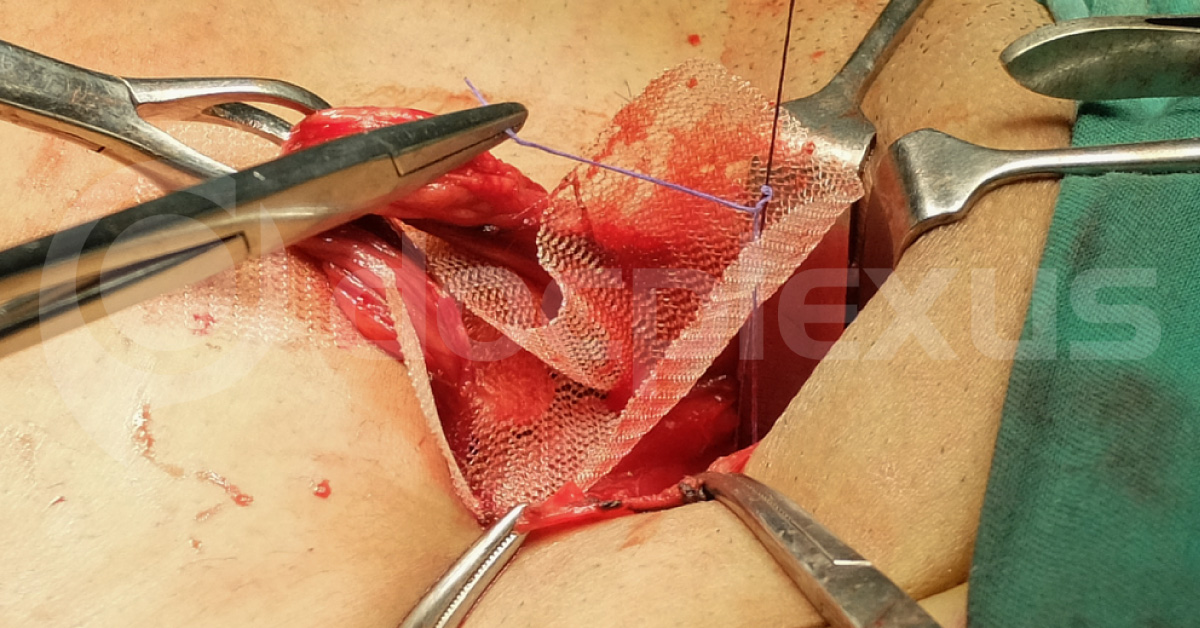 Managing Postoperative Complications In Hernia Surgery