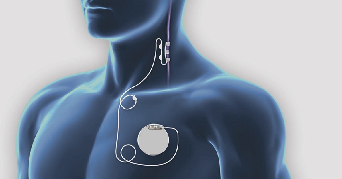 Vagus Nerve Stimulation for the Treatment of Epilepsy