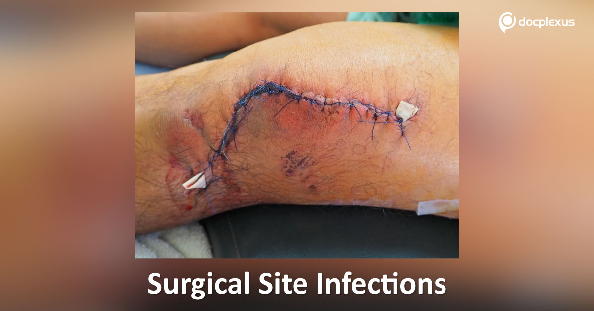 Surgical Site Infections: Causes And Risk Factors