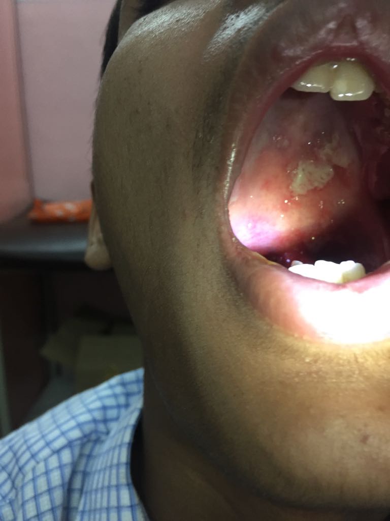 Recurrent Severe Aphthus Ulcer Cause? 