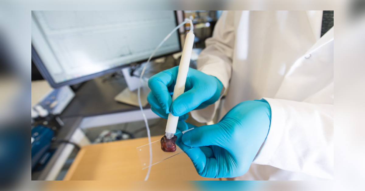 A Handheld Pen Will Diagnose Cancer Cell In Body Or Biopsy, Revolution In Cancer Surgery