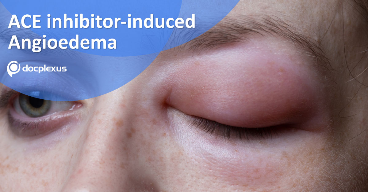 ACE Inhibitor Induced Angioedema, Which Therapeutic Do You Prefer