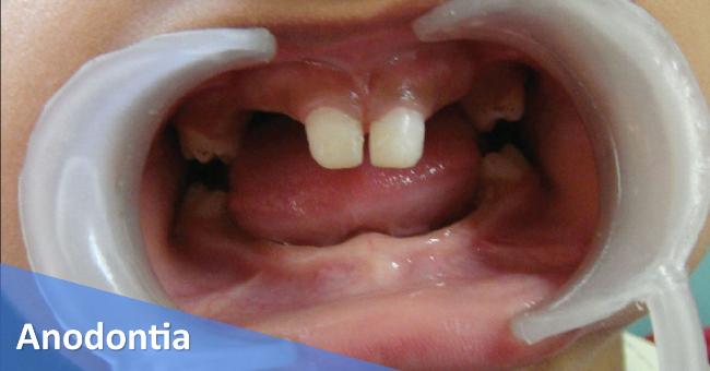 Dental Rare Disease Anodontia