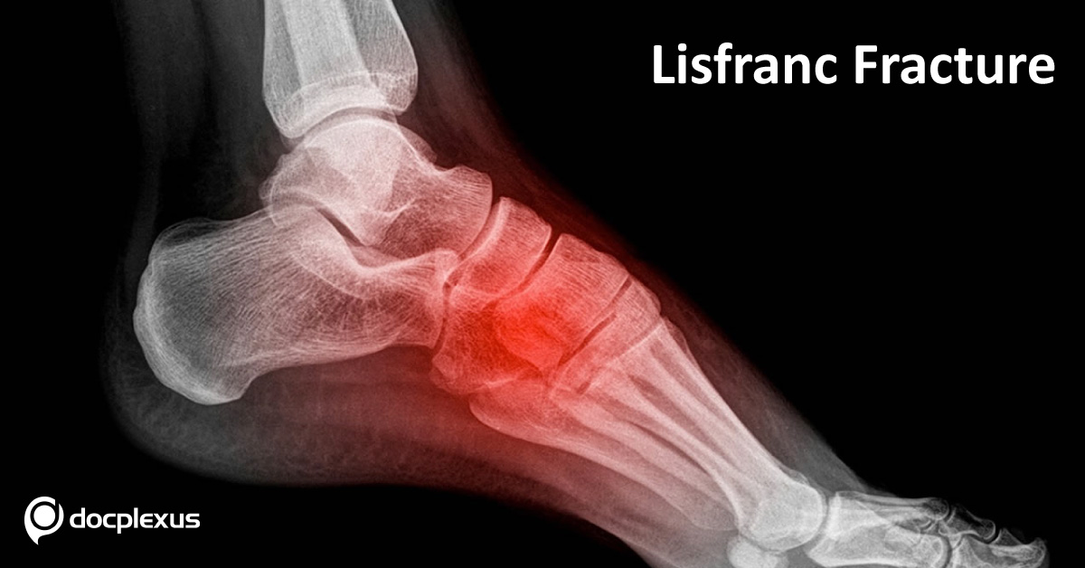 Lisfranc Fracture, Overview Of Commonly Missed Injury