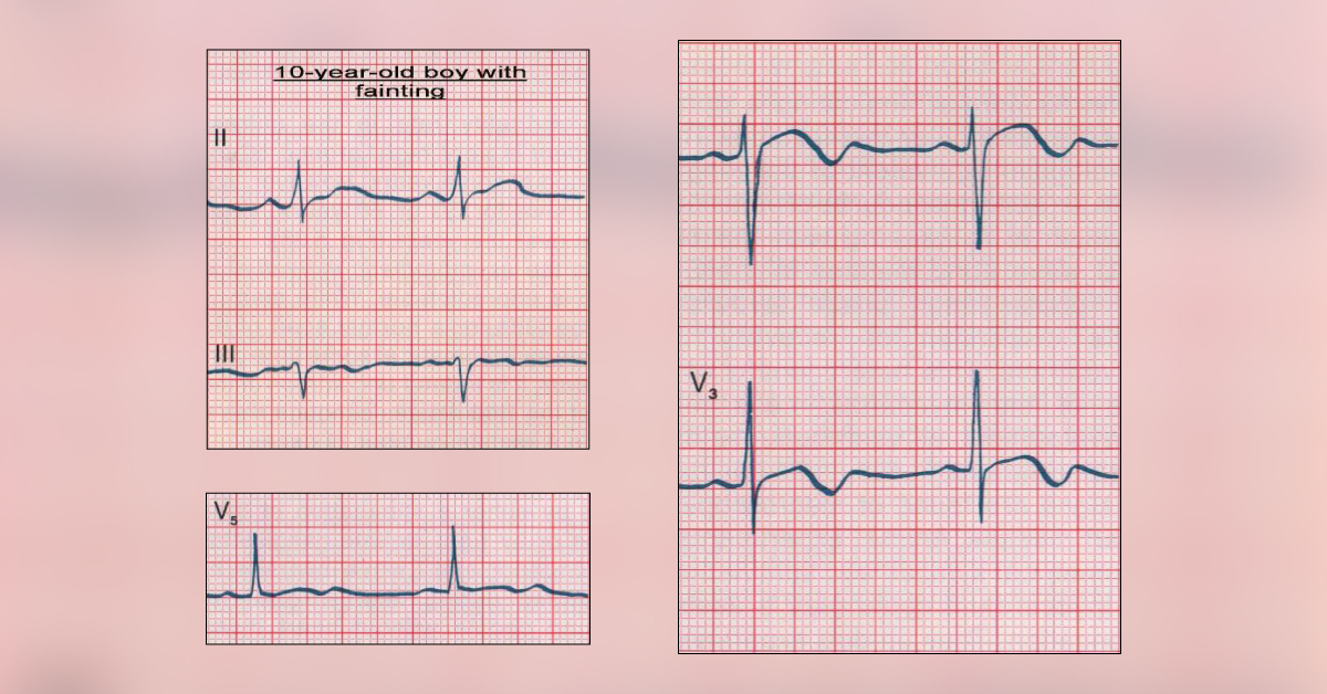 Diagnose The Cause Of Recurrent Syncope In Pediatric Patient
