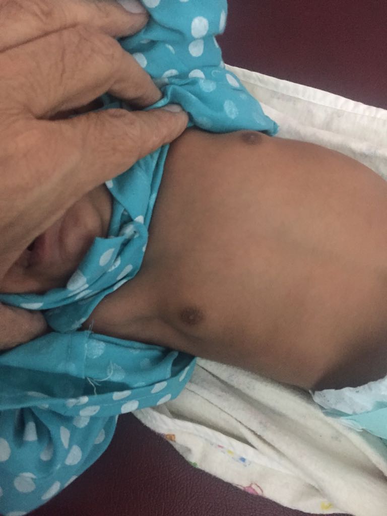 Breast Enlargement In Neonate, Normal Or Abnormal?