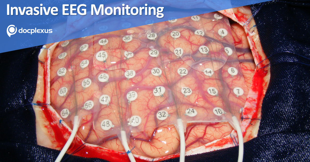 Complications Associated With Invasive Epilepsy Surgery Workup