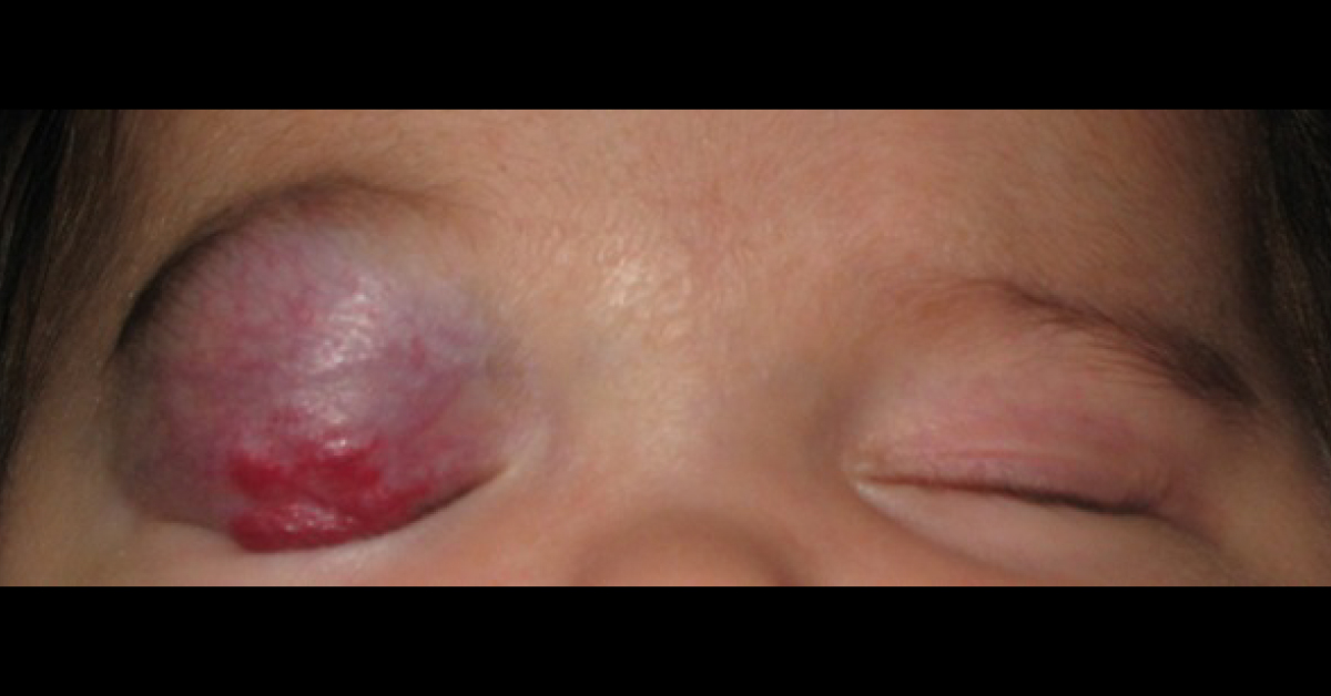 A Case Of Occlusive Vascular Lesion