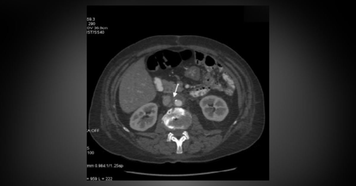 Rare Case Of Painful Abdomen
