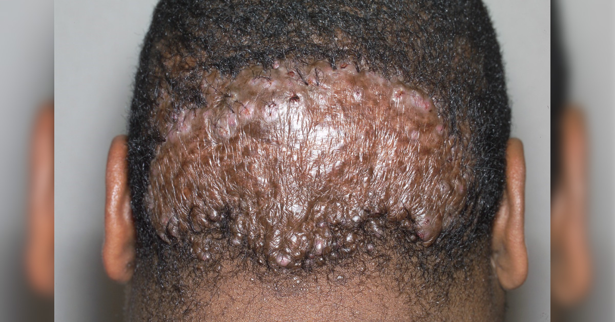 Identify This Dermatological Condition