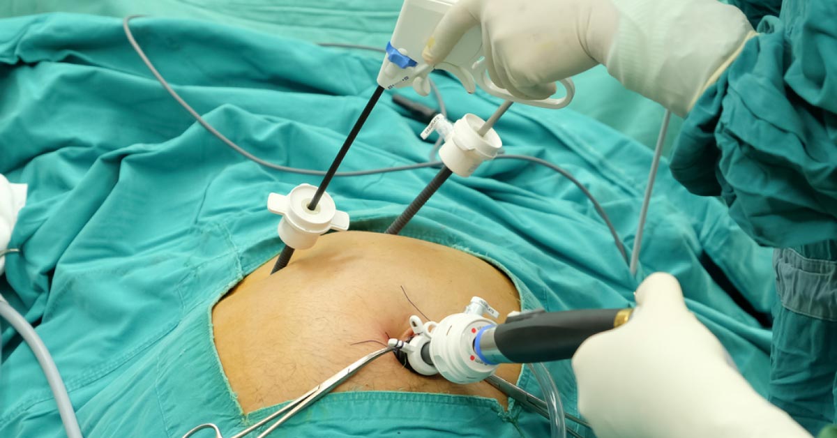 A New Approach To Gallbladder Surgery