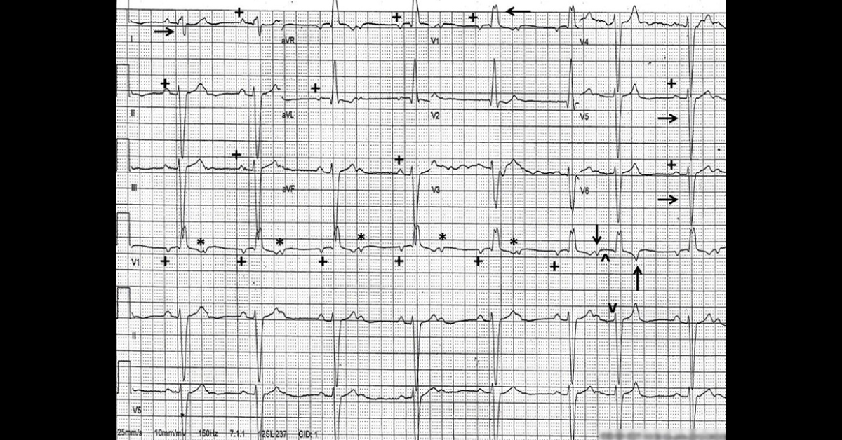 Solve This Case Of Hypertensive Crisis