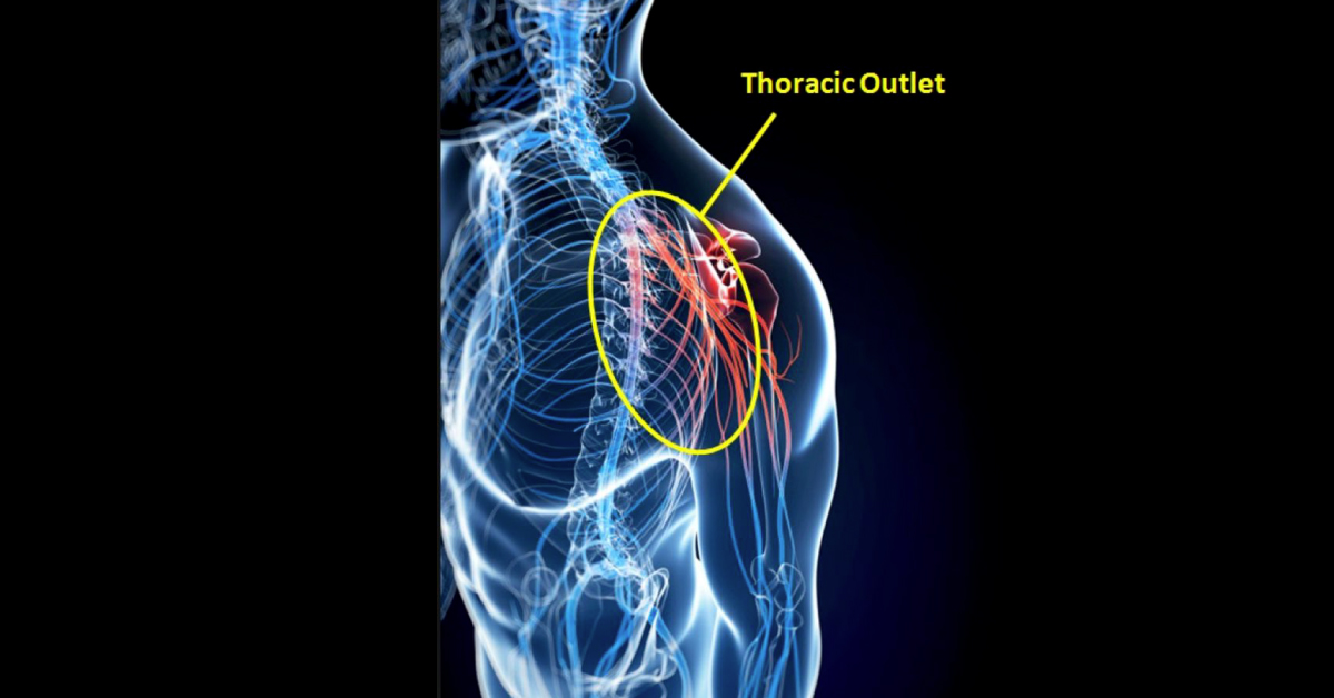 A Very Rare Presentation Of Thoracic Outlet Syndrome With TIA