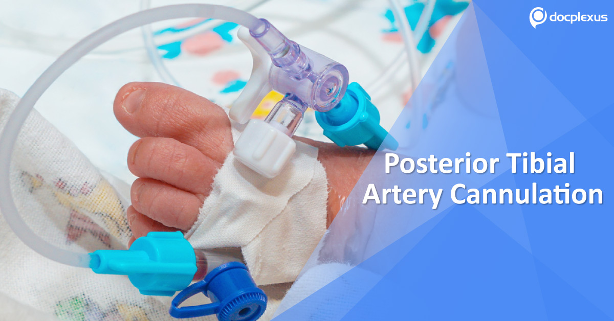 Posterior Tibial Artery: Reasonable Arterial Cannulation Site In Children