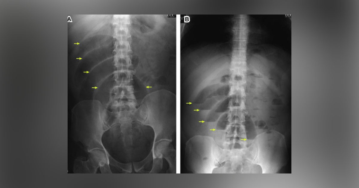 Rule Out The Cause Of Left Sided Abdominal Pain