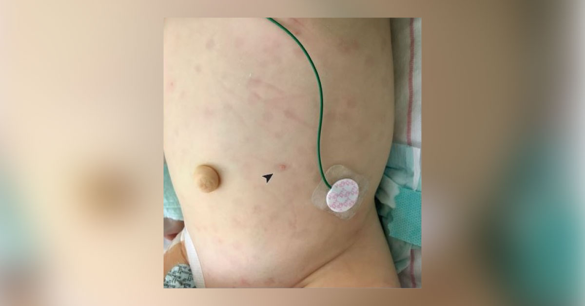 Strange Pink Papules And Blue Grey Macules