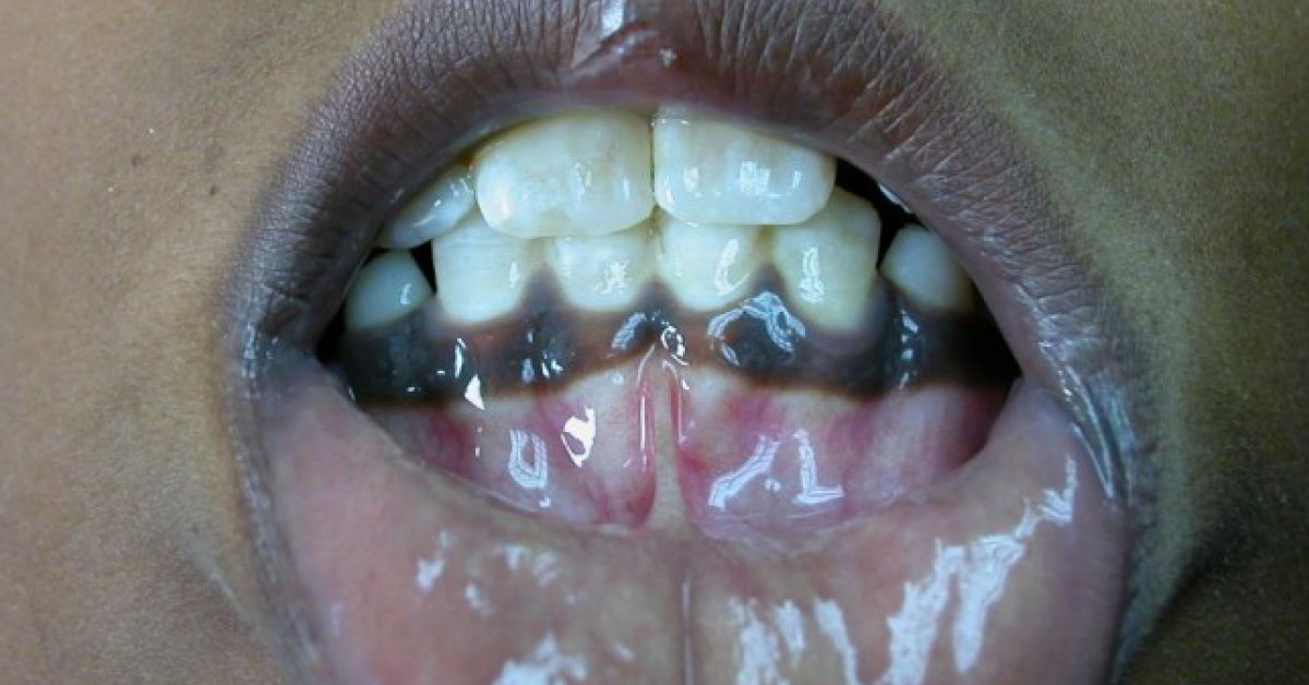 Diagnose This Oral and Dental Condition