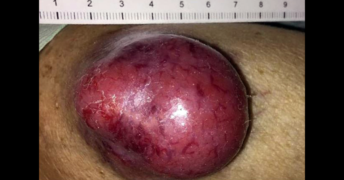 What Are These New Nodules In Multiple Myeloma?