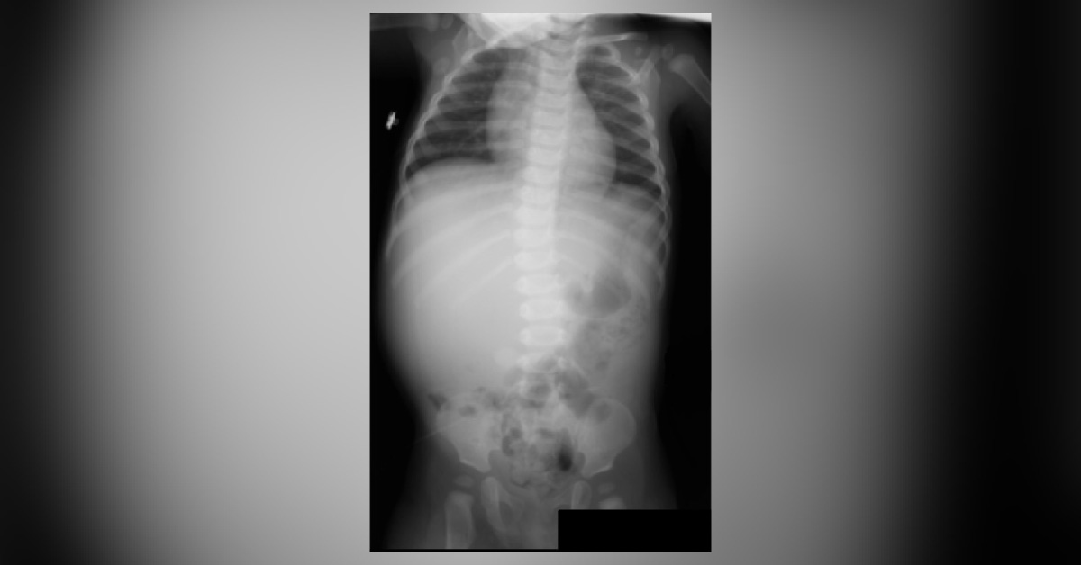 Identify The Abnormality From Young Boy Radiograph