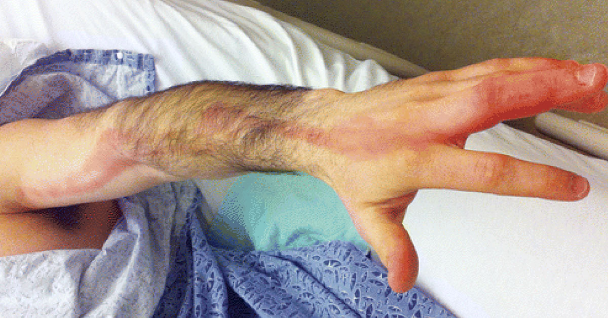 Infection And Erythematous Streaking Till Axilla