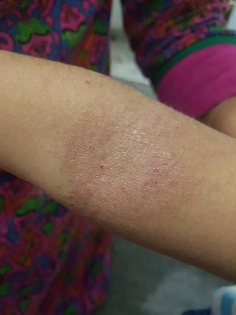 What Is This Skin Lesions? Part -2