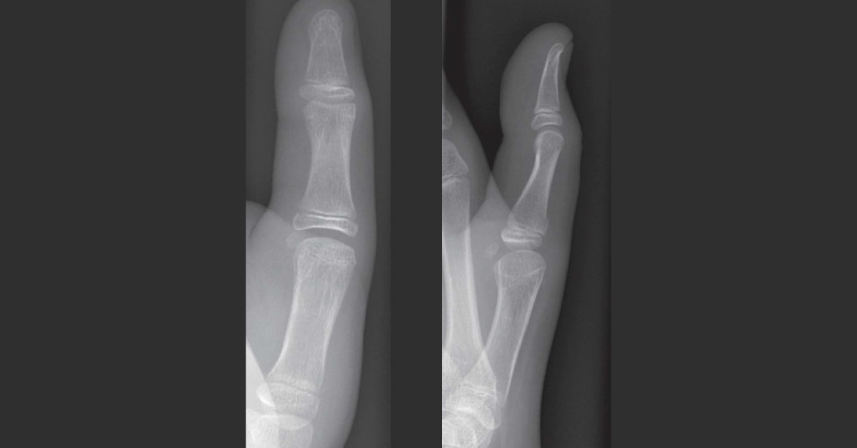 Is There Any Fracture