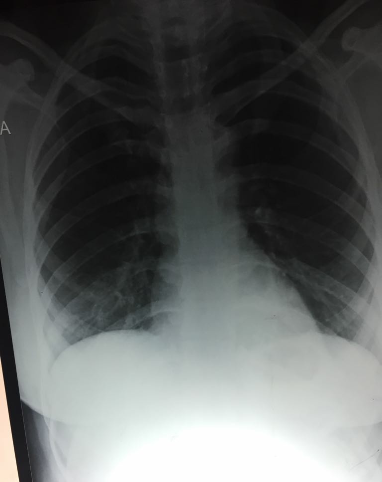 Is There Any Pathology At Right Lower Most Zone ?