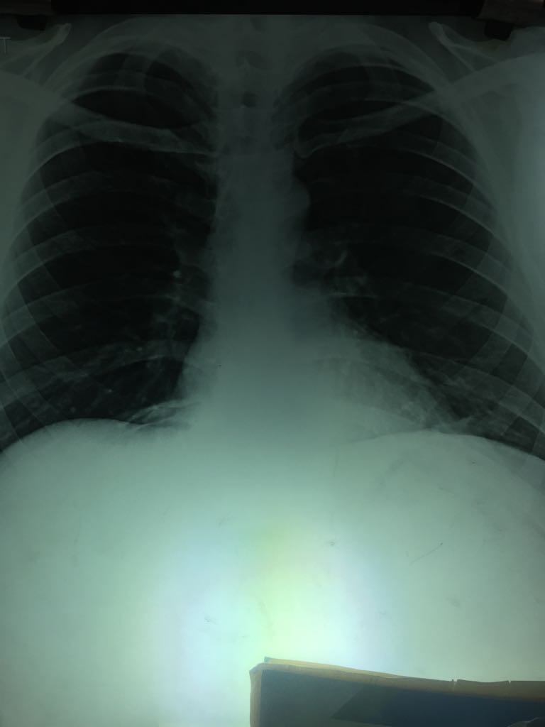 What Is This Bony Structure In Rt Lower Zone? 