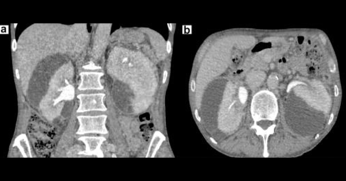 A Case Of Adult Male With Urinary Retention