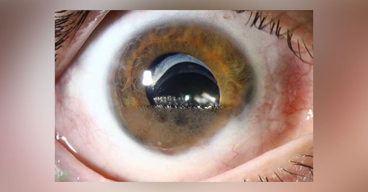 Identify Cause For This Eye Condition