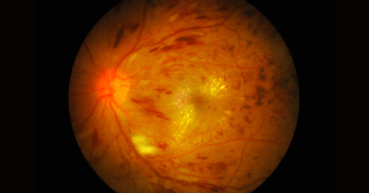 Visual Impairment Caused By Macular Edema: Ranibizumab Therapy NICE Guidance