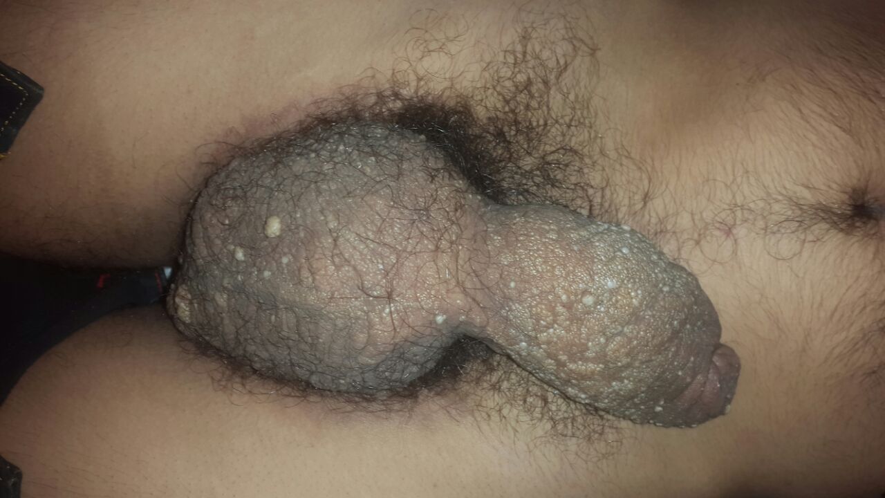 Is De-roofing Of Dilated Lymphatic Into Peritoneum Is An Option