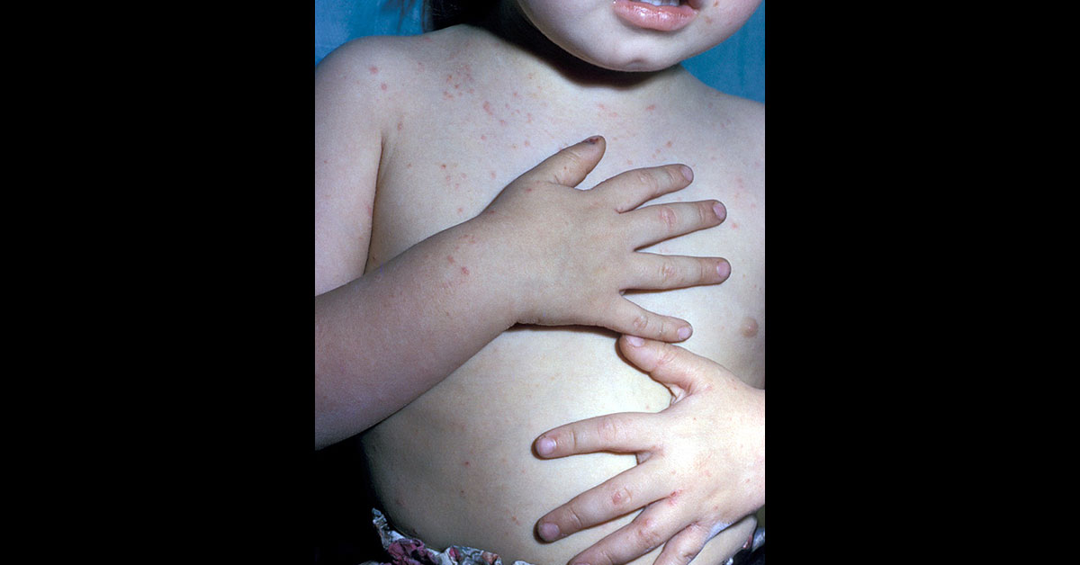 Diagnose The Papular Lesions On Pediatric Patient