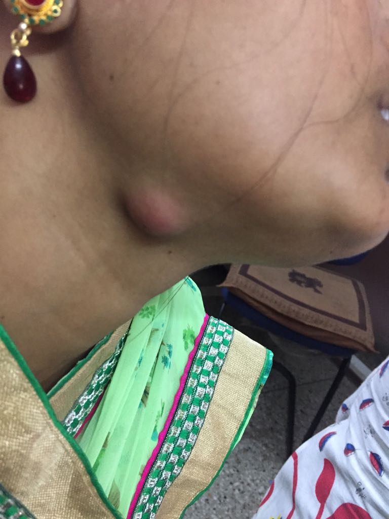 Recurrence Of Thyroglossal Cyst, To Be Operated Or Medical Treatment?