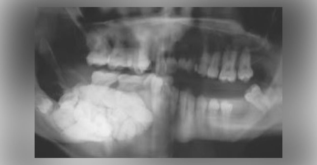 Case Of Painless Bony Swelling
