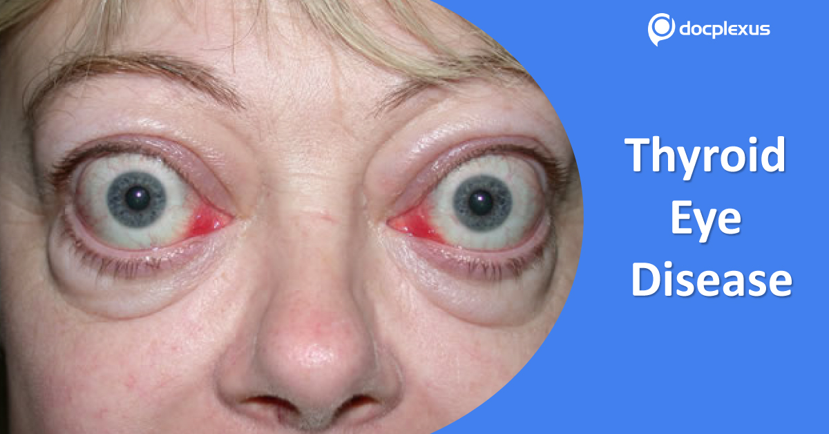 Retrobulbar irradiation for thyroid eye disease: National Institute for Health and Clinical Excellence