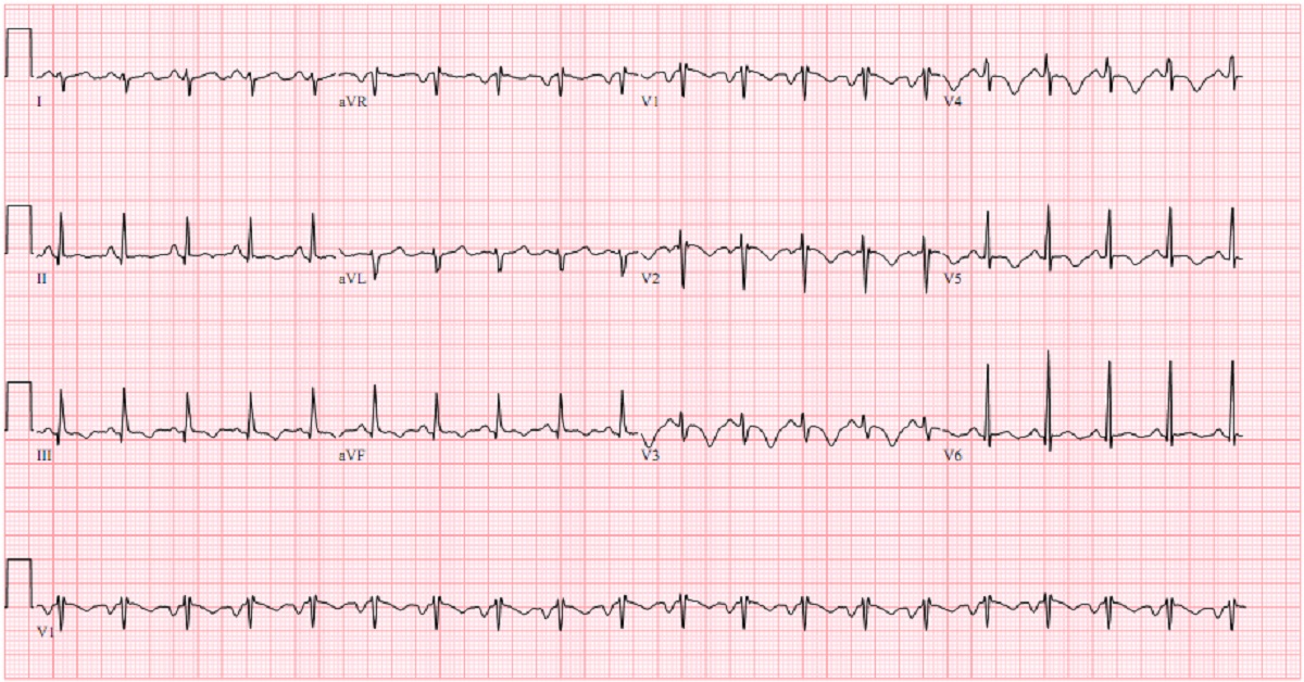 Conclude This ECG