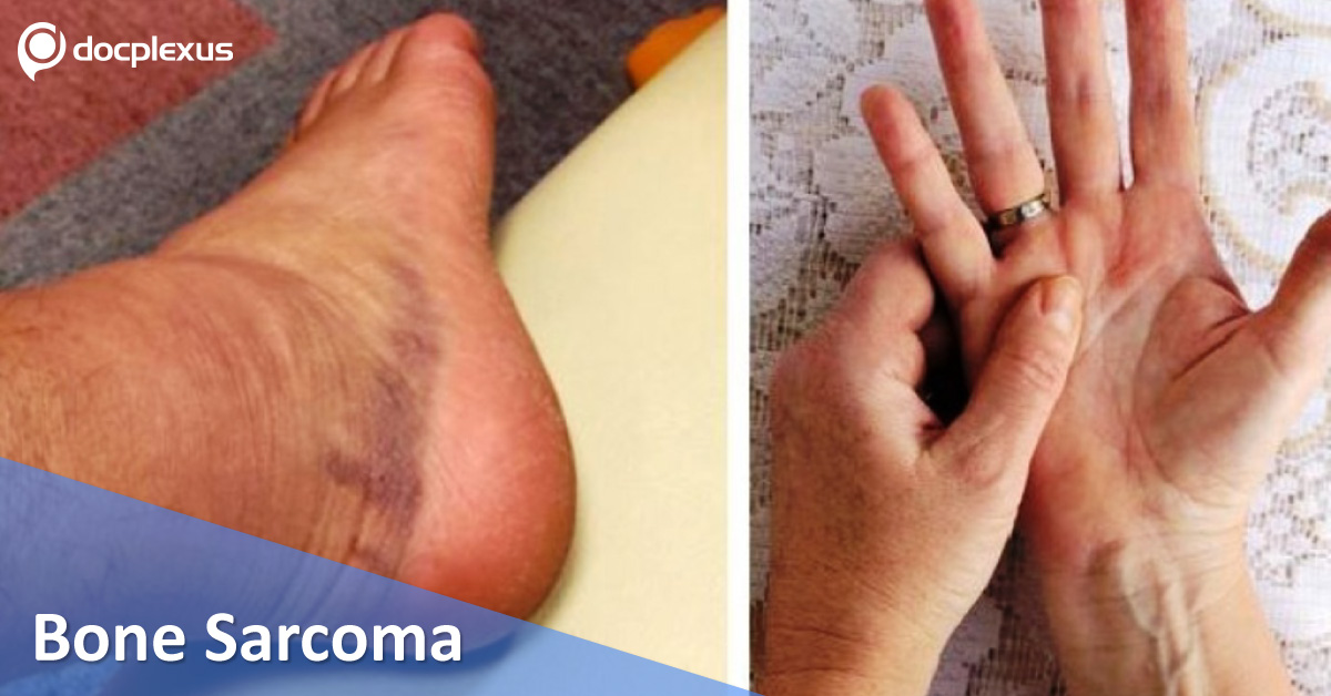 Bone Sarcoma, Clinical Recommendations