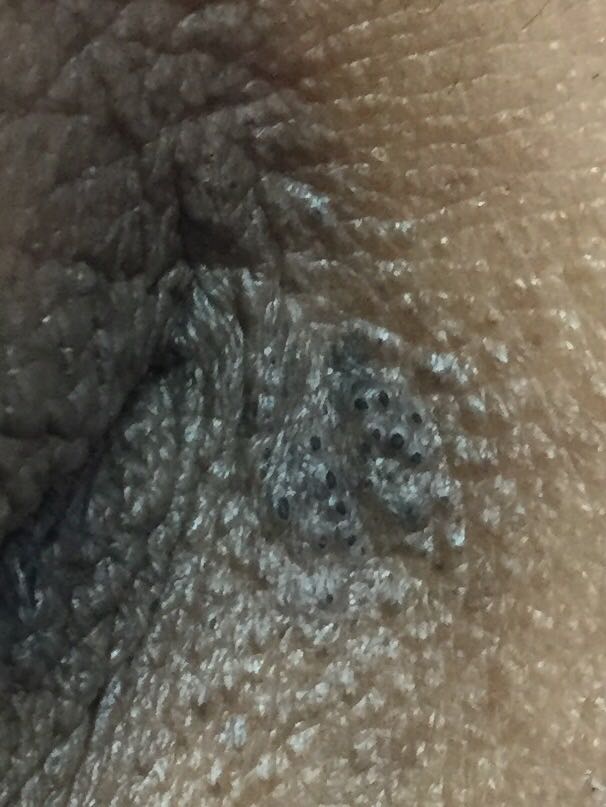 Patient Wants To Remove These Black Head At Medial Canthus Of Both Eyes