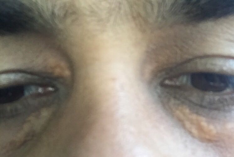 What Is The Best Treatment For Xanthelasma