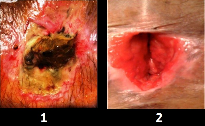 Anal Trauma After Accident