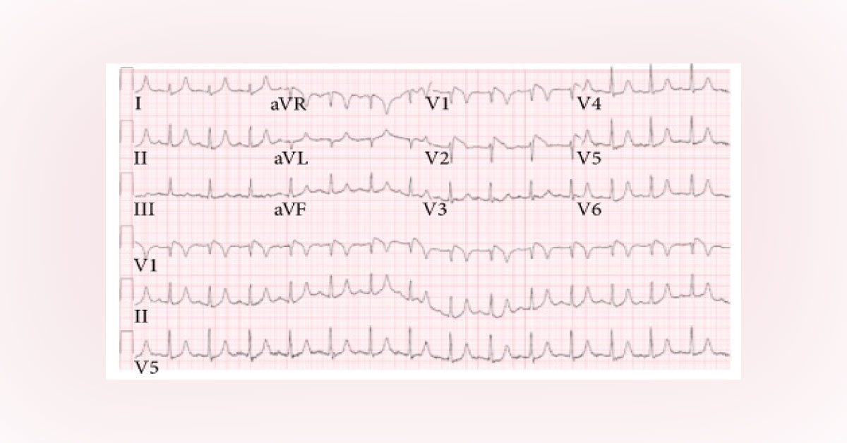 Identify The ECG Abnormality