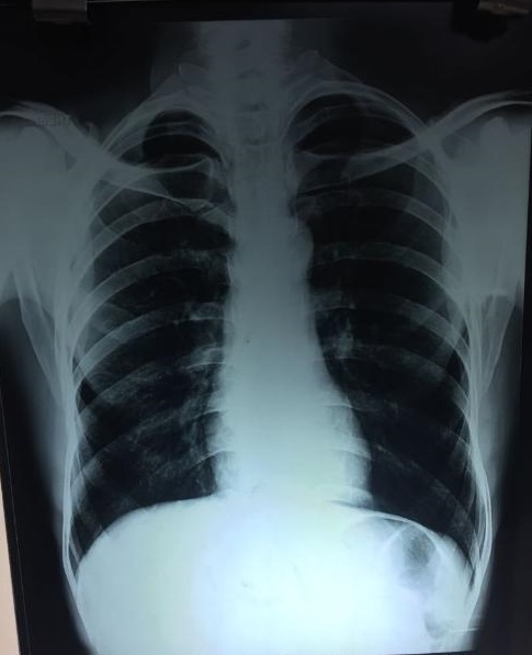 Why Lung Markings Are Very Less? 