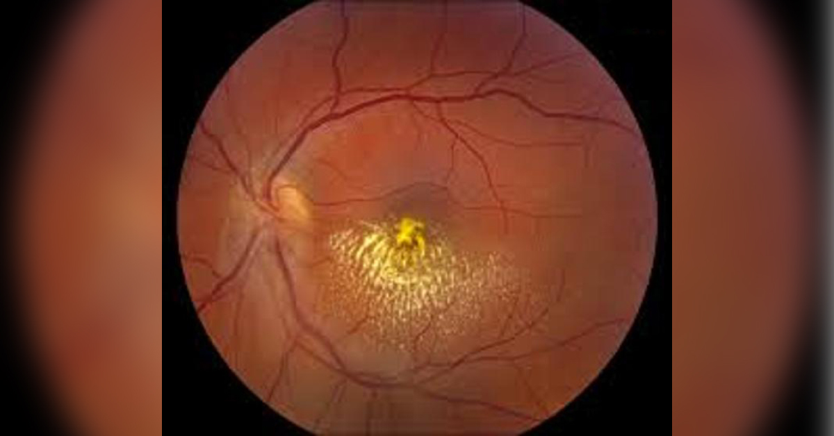 Brief Scenerio Of Coats Disease