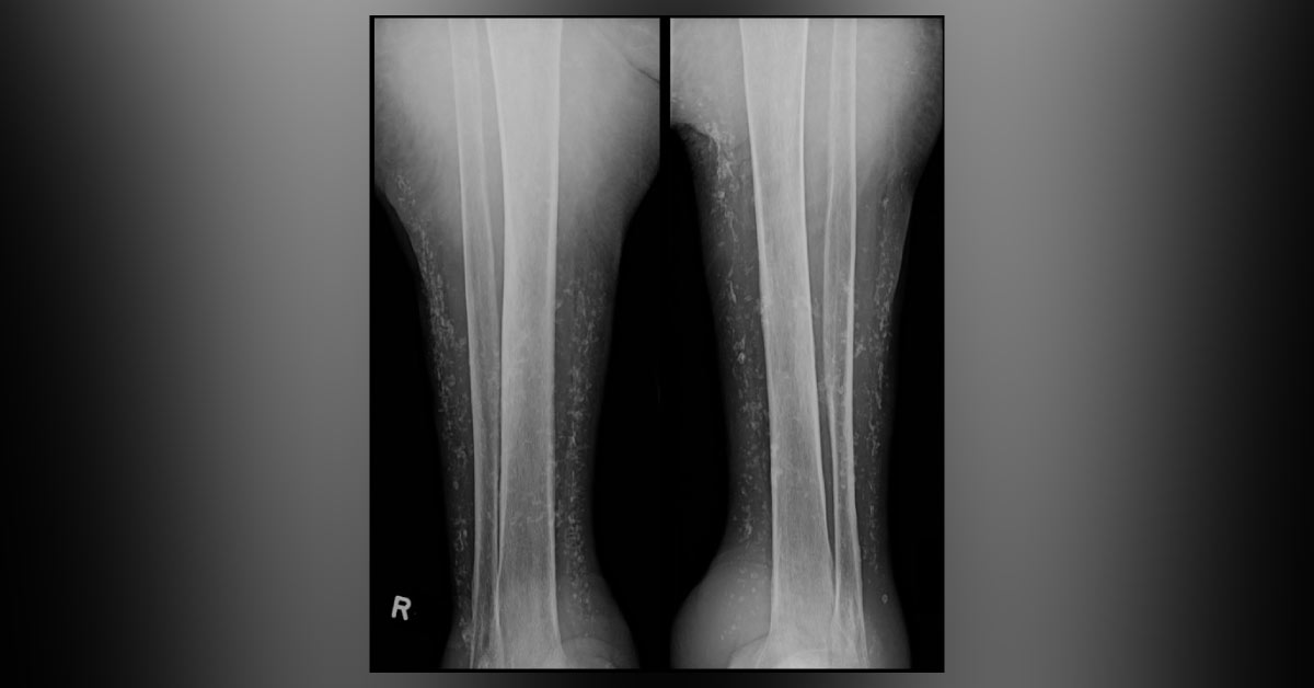 Diagnose The Swelling Of An Old Man