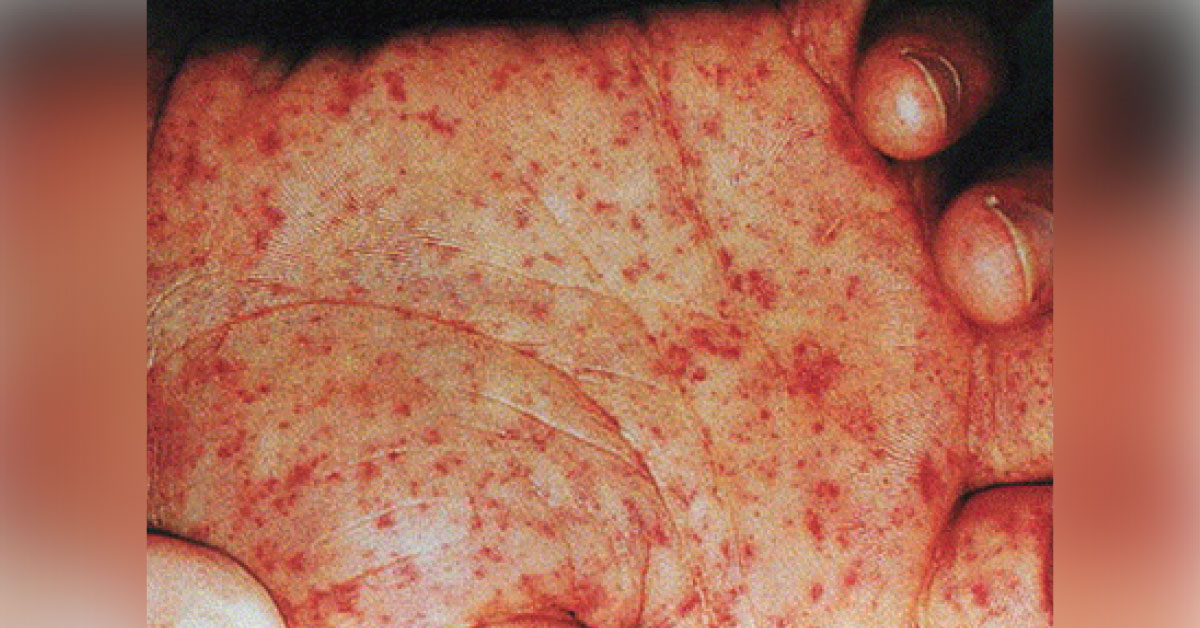 What Should Be Initial Treatment?